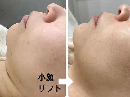 【医療提携】ヒト幹細胞原液100% Re.GLARE新宿/毛穴洗浄/ハイドラ/ハーブ/肌荒れ/小顔の写真