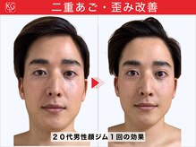 那賀洋子式 顔ジム 大分戸次店/20代男性顔ジム1回の効果