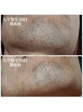 ビメンズ(BiMen's)/ヒゲ脱毛 before★after