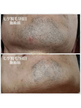 ビメンズ(BiMen's)/ヒゲ脱毛 before★after