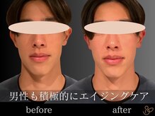 チョコバリ 恵比寿店(chocobari)/小顔リフトアップ（美容鍼）20代