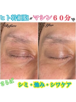 カルマーアンドビー(Calmer & Be.)/【ヒト幹細胞】Before/After