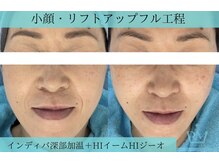 リメイククリニカルビューティー(Remake clinical beauty)/フェイスライン改造