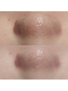 マイフェアレディ 今池(MyFairLady)/毛穴洗浄★ハイドロフェイシャル