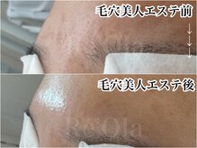 ニュートラル(neutral)/【毛穴エステ】ツヤ爆誕！