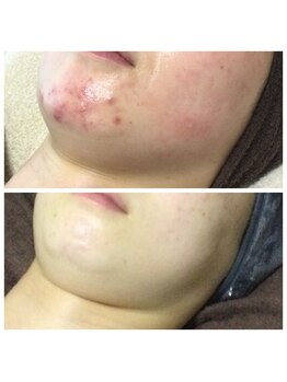 リラーナ(Re rana)/大人ニキビケア♪