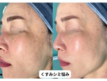 リメイク 銀座(REMAKE)/幹細胞ゴールドピーリング