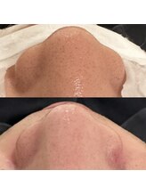 パルティール 渋谷店 partir/黒ずみにも！ビフォーアフター