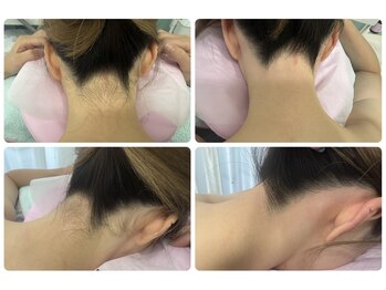 ラリュール(L'ALLURE)/うなじのシュガーリングワックス