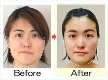 小顔矯正エステ プリュムレーヴ