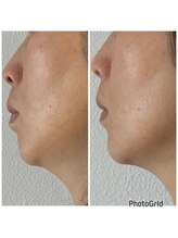 ピュアプラス(Pure Plus)/Before/After