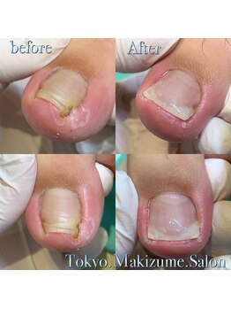 【巻き爪/陥入爪】