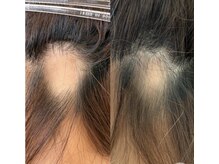 カナエル ビューティーサロン(Canael Beauty salon)/プロセルセラピーズ　3回