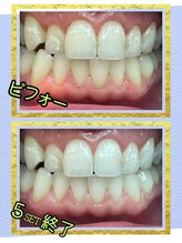 セルフドビューティーケイナックス(SELF d'e BEAUTY K-nacks)/ビフォーアフター５セット