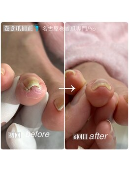 痛みを繰り返ししてまう巻き爪