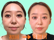 ナチュラルパーフェクトフェイス 新宿/タルミ、二重顎、ほうれい線