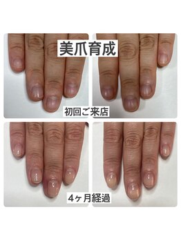 マニュコクーン(ManuCocoon)/爪育成 深爪 巻き爪 大阪市