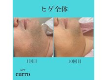 アクト クロ(ACT curro)/【ヒゲ全体】脱毛施術例
