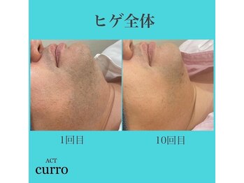 アクト クロ(ACT curro)/【ヒゲ全体】脱毛施術例