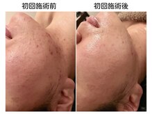 ビューティースパ/ニキビケア→自信の持てる肌へ