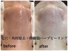 デューン 蕨店(Dune)/1度でbefore/after毛穴洗浄★