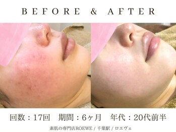 ロエヴェ(ROEWE)/ニキビ改善・毛穴ケア・肌質改善