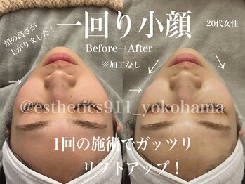 エステティックス ナインワンワン 横浜(Esthetics911) /美白になり一回り小顔へ