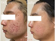 トータルビューティサロン ルボン(RUBON)/男性のニキビケア症例