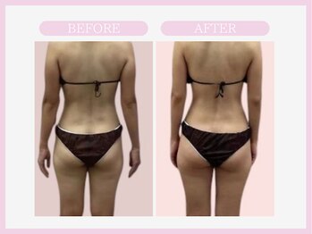 スリムライン 秋田店(The Slim Line)/before→after