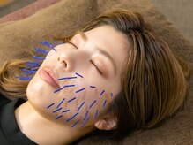 ボニー(Bonnie)/【美容鍼灸】