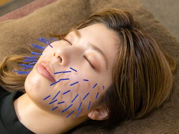 ボニー(Bonnie)/【美容鍼灸】