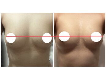 ルミエール(Lumiere)/【倉敷市】バストアップ施術事例