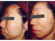 ビューティースパ/法令線.なぜか老けて見える…。