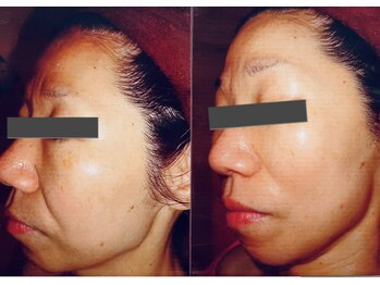 ビューティースパ/法令線.なぜか老けて見える…。