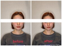 小林整骨院 本町/【肌質改善美容鍼】