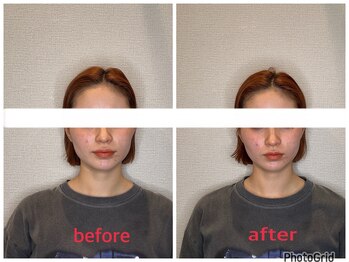 小林整骨院 本町/【肌質改善美容鍼】