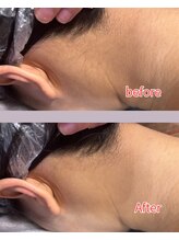 フェリーチェ 大塚店(Felice)/後ろ姿に自信◎うなじ脱毛♪