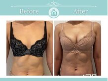 美人バスト 新潟店/ 【バストアップ★育乳】症例