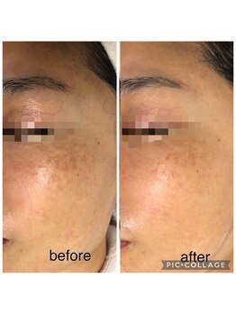 エスカル ボーテ(escale beaute)/シミケア