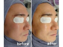 ビューティーアンドビースト(Beauty&Beast)/◆超敏感悩み◆beforeａｆｔｅｒ