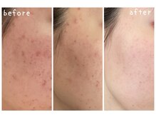 ビードット バイ ソーフライ(B.by So fly)/さまざまなお悩みに！