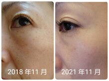 ブラックフェアリー(Black Fairy)の雰囲気（◆ビフォーアフター画像◆年齢を重ねて出てくるお悩みに。）