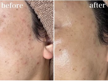 ホワイトアクア 浜松店(WHITE AQUA)/ララピール/ニキビケア