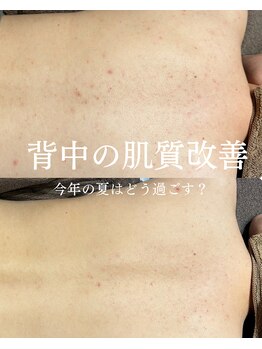 インテリウス(INteRius.)/背中ニキビケア