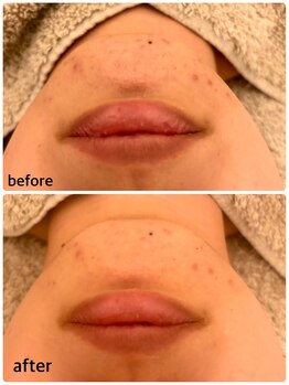 カルア(CALUA)/1回での効果/ハーブピーリング