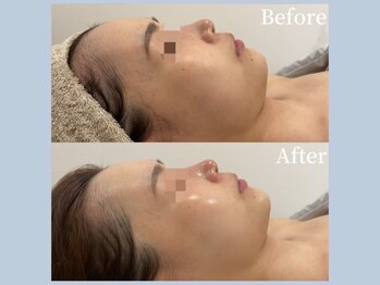 アイミーモア 国立店(aimer more)/陶肌トリートメントBef＆Aft