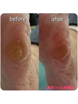 上高田つつじ整体院/タコ　フットケア　