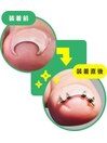 巻き爪矯正