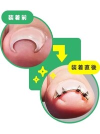 巻き爪矯正