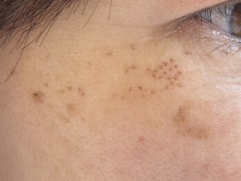 サクラ(SAKURA)/シミを垢にして排出